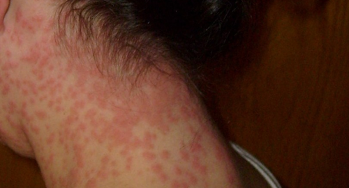 Kawasaki Disease