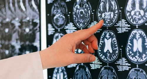 Ultra-Rare Disease: Joubert Syndrome